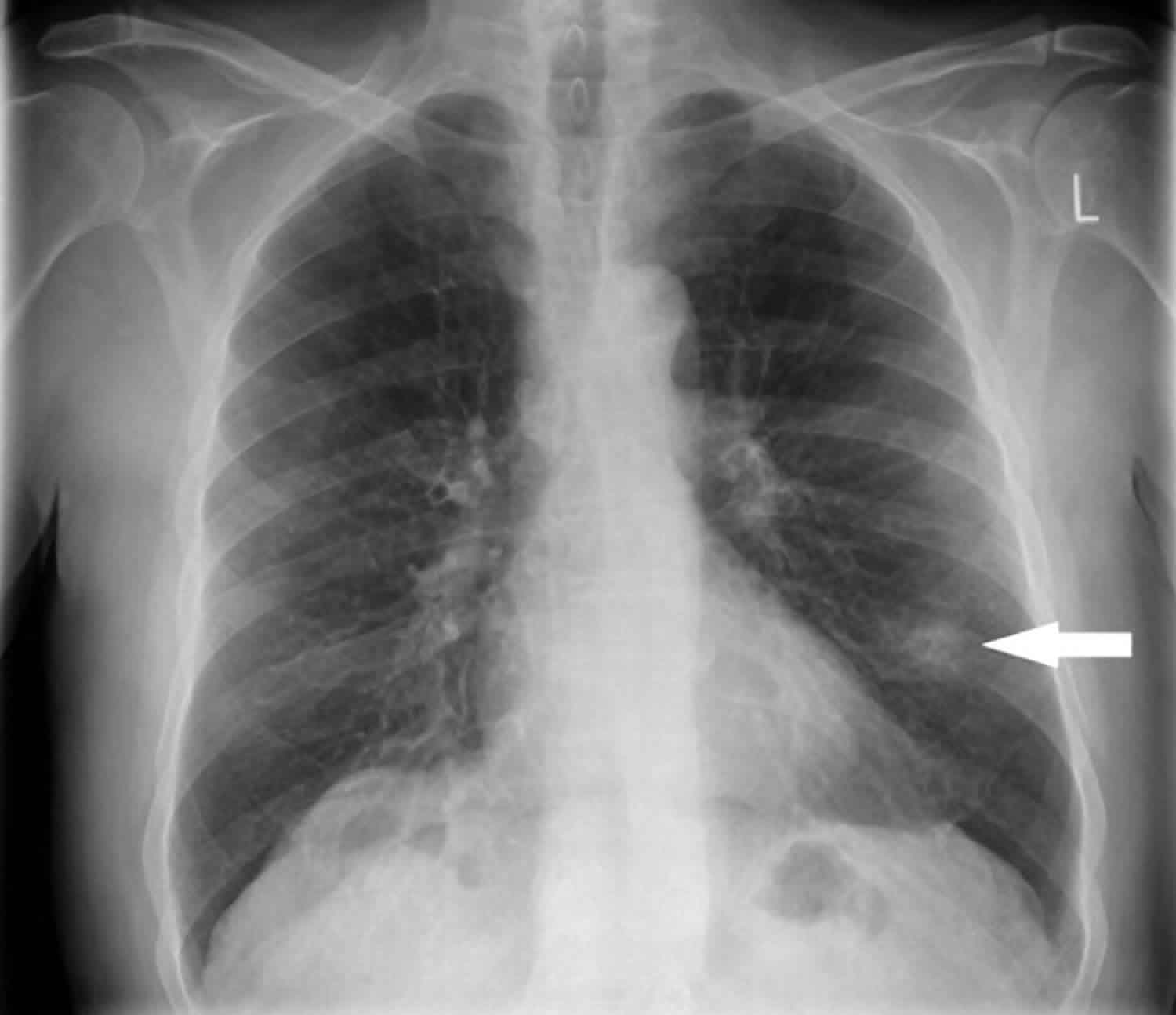 lung nodules pictures