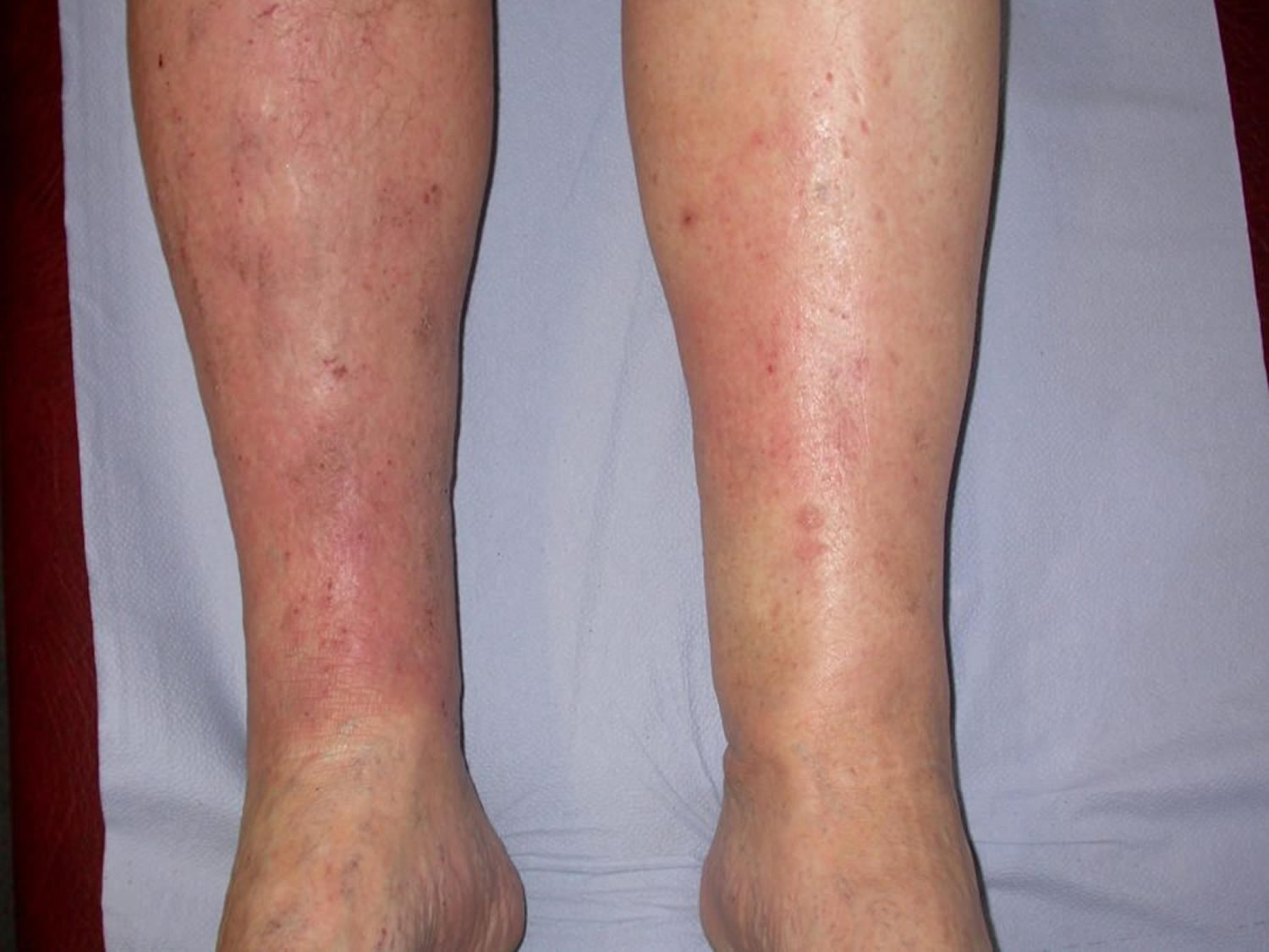 Ankle Discoloration – What is Stasis Dermatitis? - Veins Charlotte