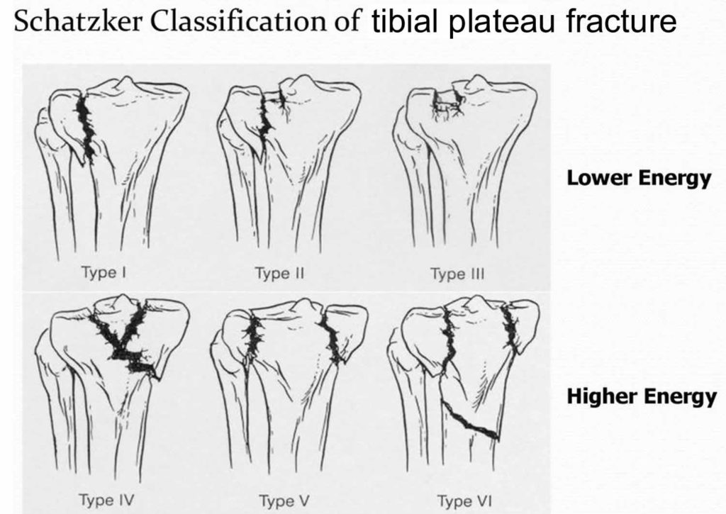 Tibial plateau fracture causes, types, symptoms, diagnosis & treatment