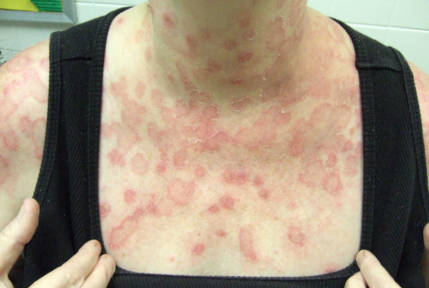 Tinea Rash