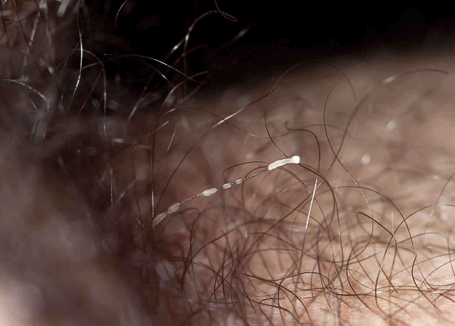 Itchy Pubic Hair: Causes and Treatment