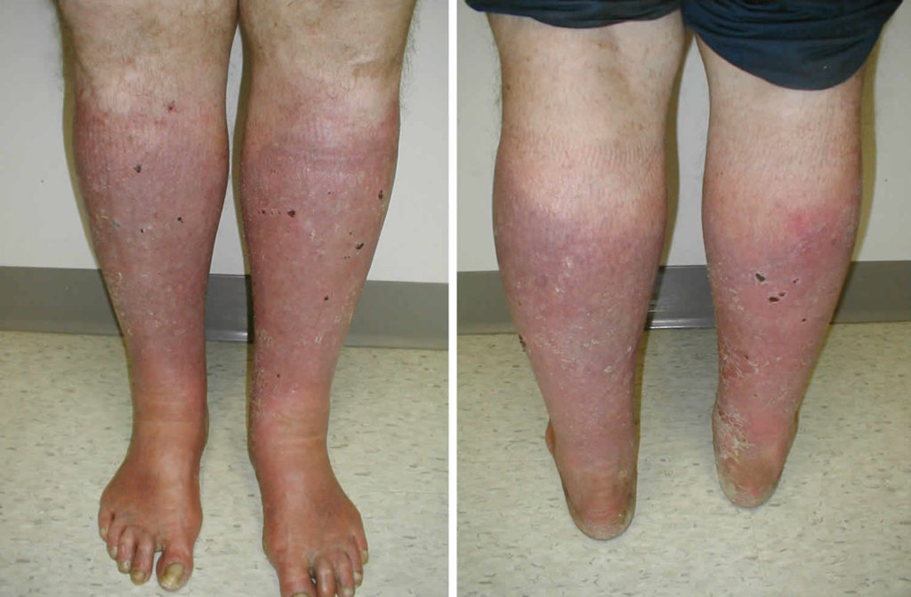 Stasis Dermatitis Causes Symptoms Diagnosis Treatment