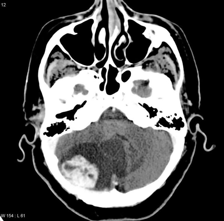 Hemangioblastoma definition, causes, symptoms, diagnosis, treatment