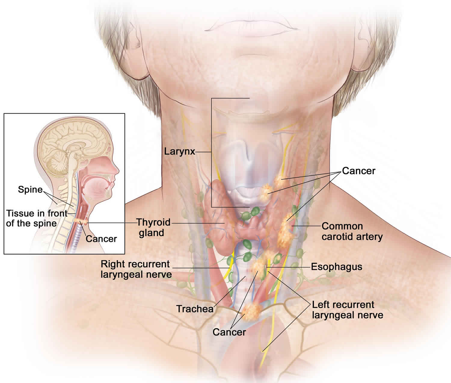 hurthle-cell-carcinoma-causes-symptoms-diagnosis-treatment