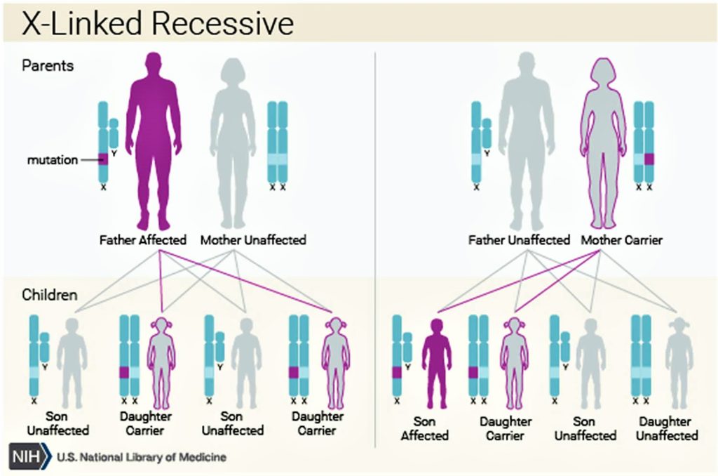 Menkes Disease Causes Symptoms Diagnosis Treatment And Prognosis