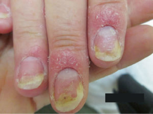 Nail Psoriasis Causes, Symptoms, Diagnosis, Treatment & Prognosis