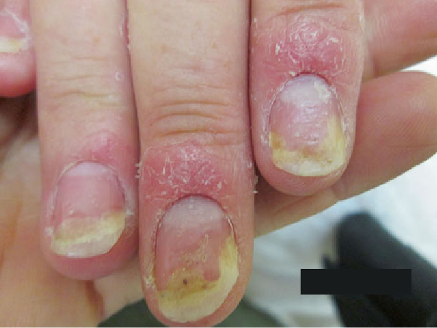 Does Psoriasis Cause Nail Ridges