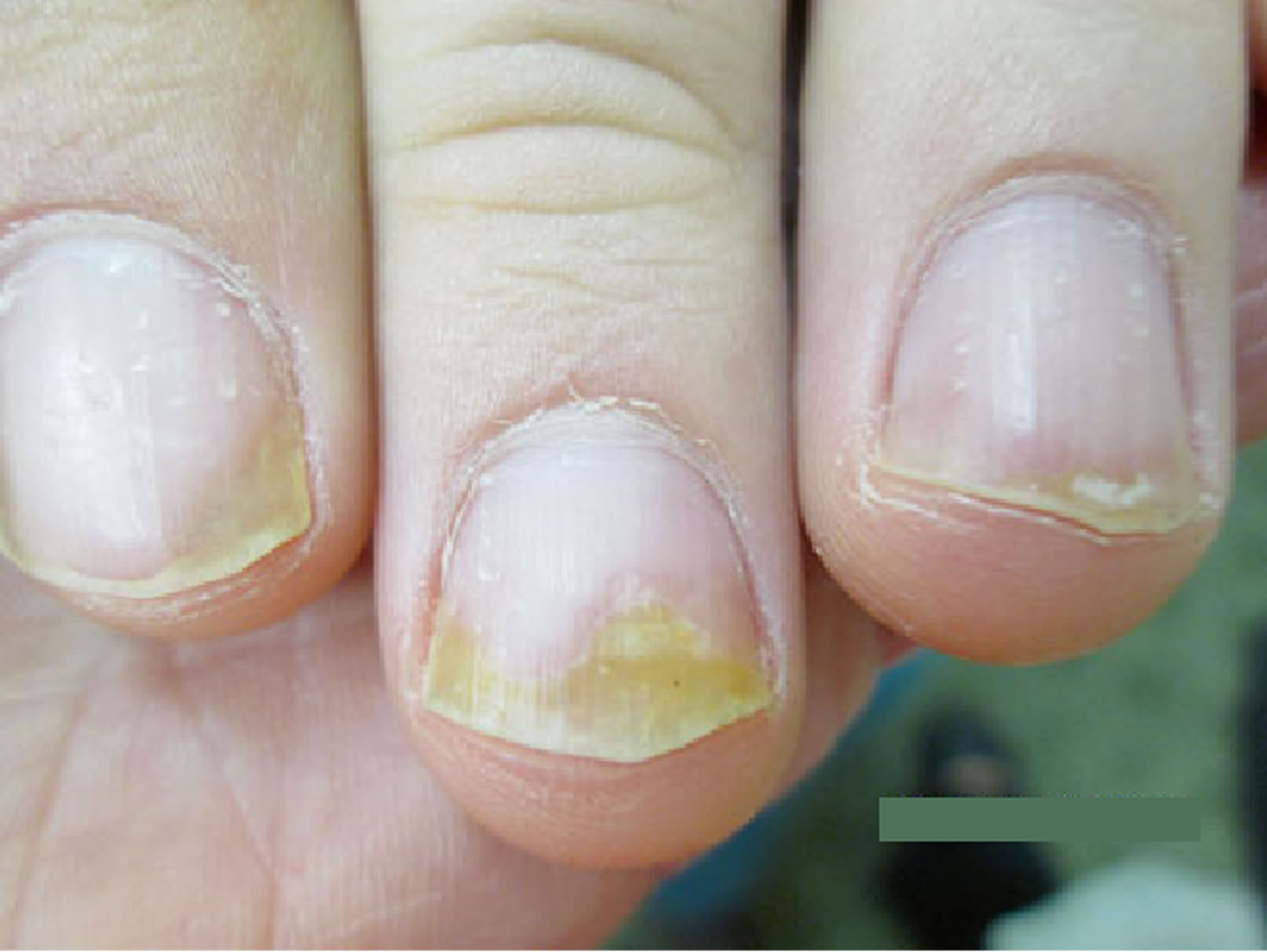 how to hide nail psoriasis)