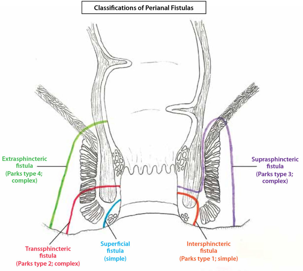 Perianal Fistula Causes Symptoms Diagnosis Treatment And Surgery