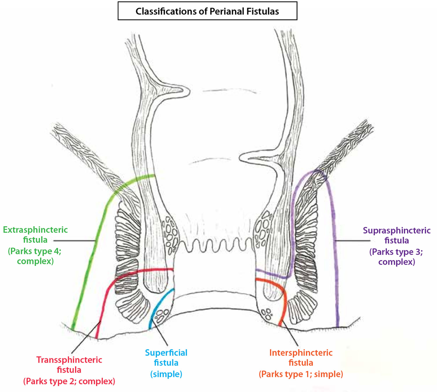 Parks classification of perianal fistula