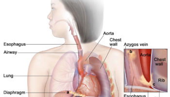 Plummer-Vinson syndrome