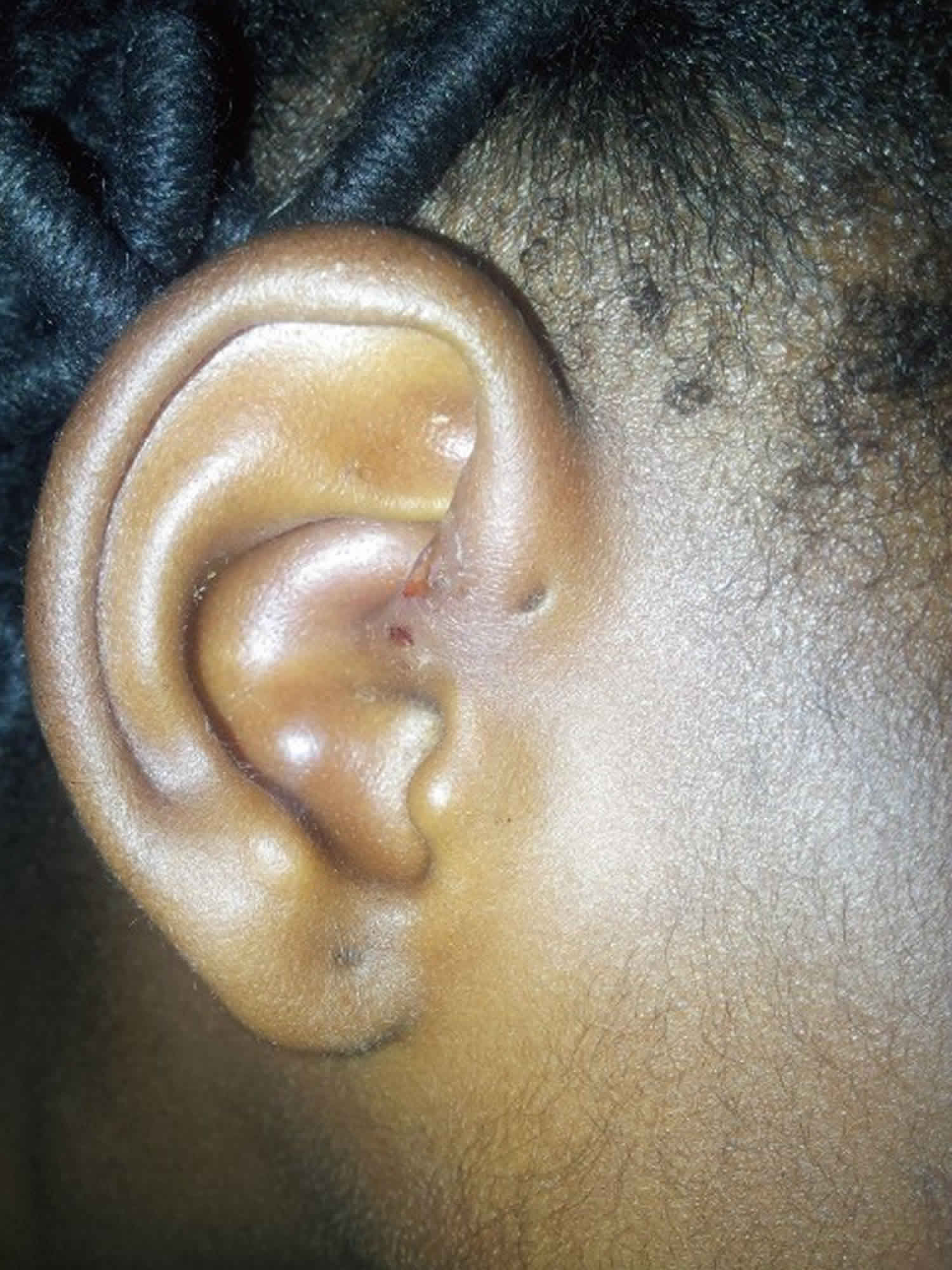 preauricular pit infection