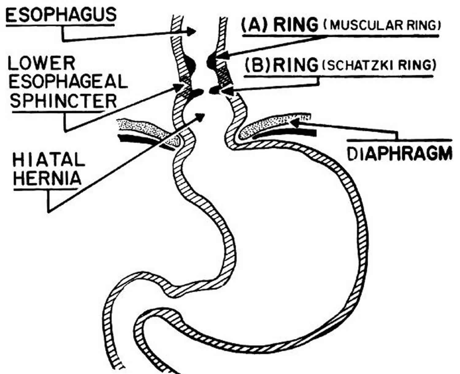 Lower Esophageal Rings, Webs, and Annular Strictures