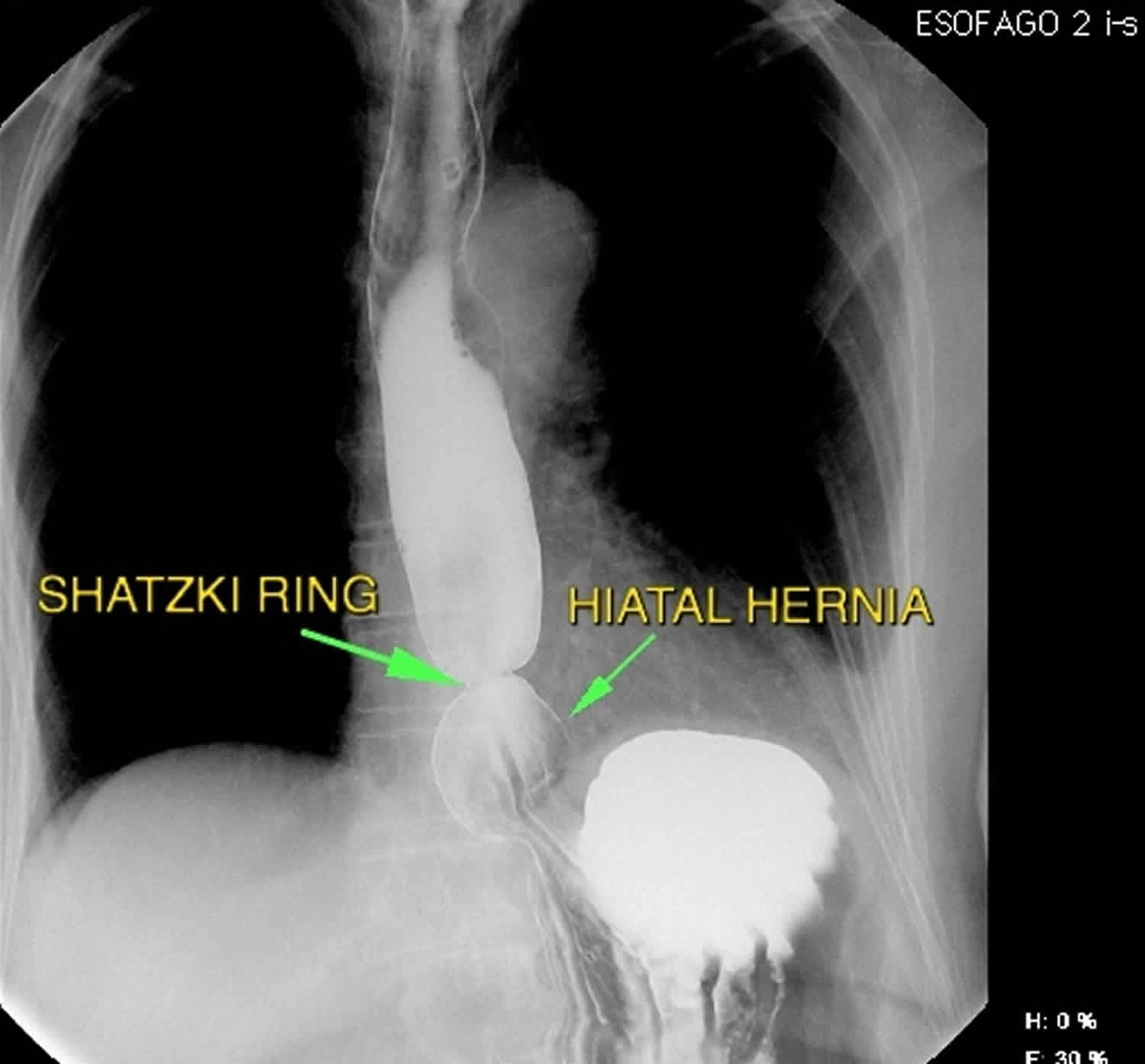 Schatzki ring | Radiology Case | Radiopaedia.org
