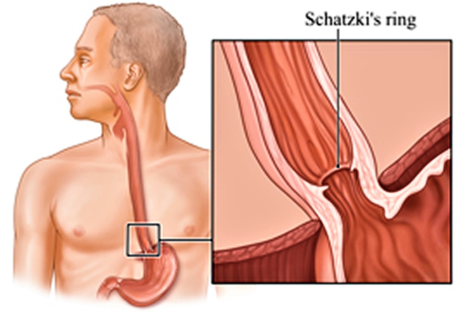 Endoscopy for Diseases with Esophageal Dysphagia | IntechOpen