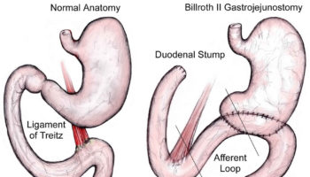 afferent loop syndrome
