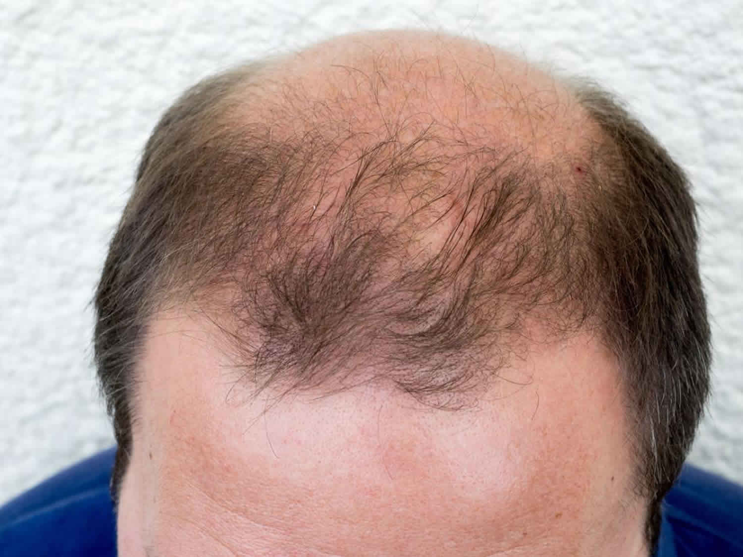 Androgenetic alopecia female & male causes, diagnosis & treatment