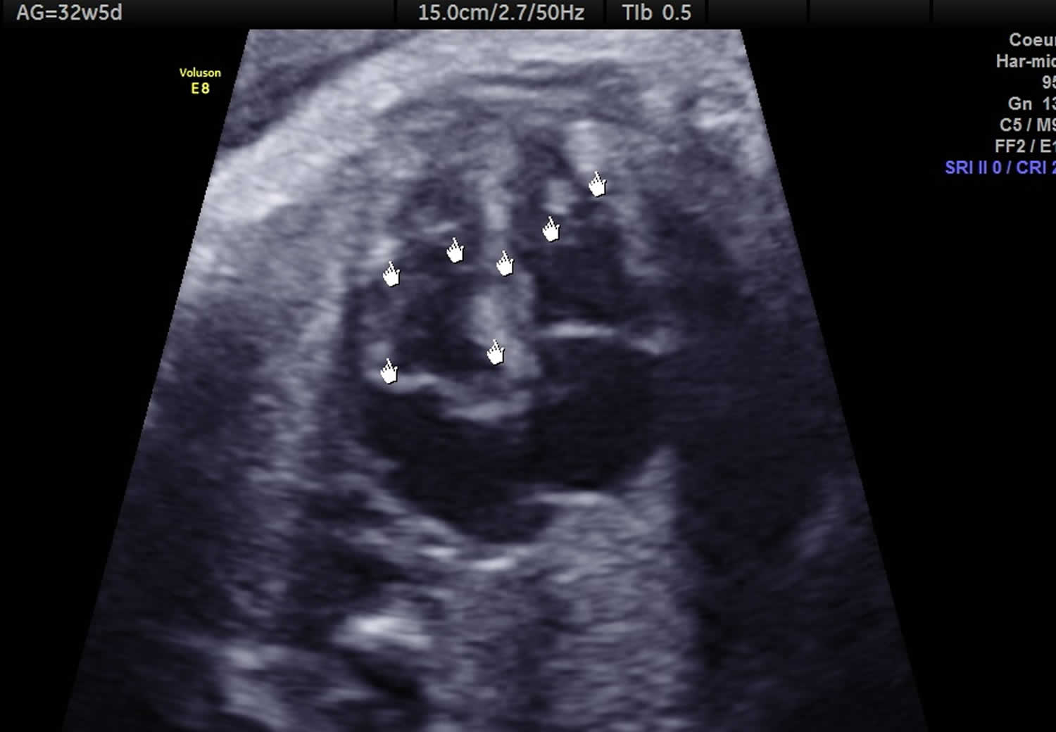 Cardiac rhabdomyoma ultrasound