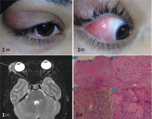 Dacryoadenitis Causes, Symptoms, Diagnosis, Treatment & Prognosis