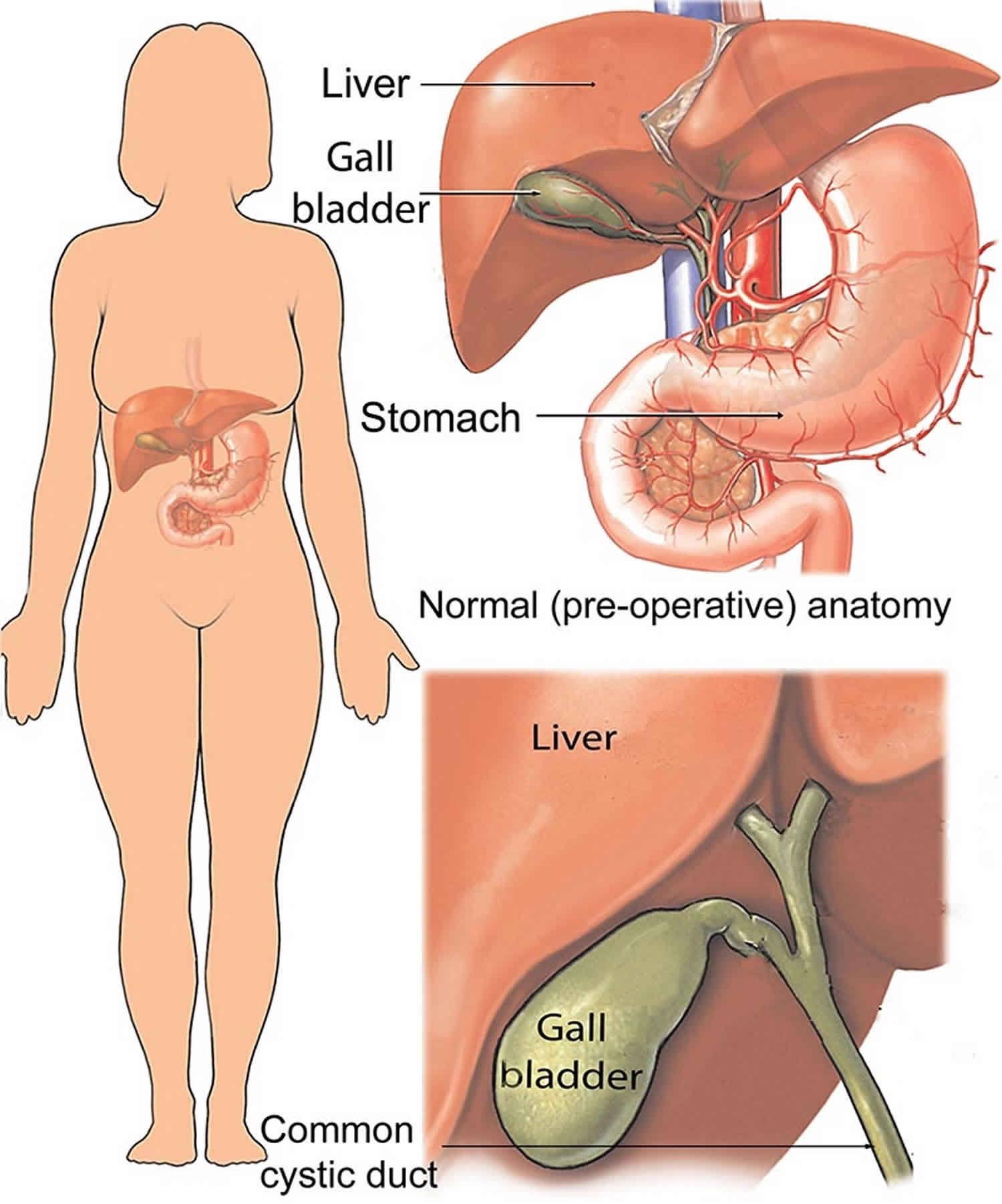 emphysematous-cholecystitis-causes-symptoms-diagnosis-treatment