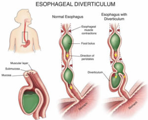 Esophageal diverticulum causes, types, symptoms, diagnosis & treatment