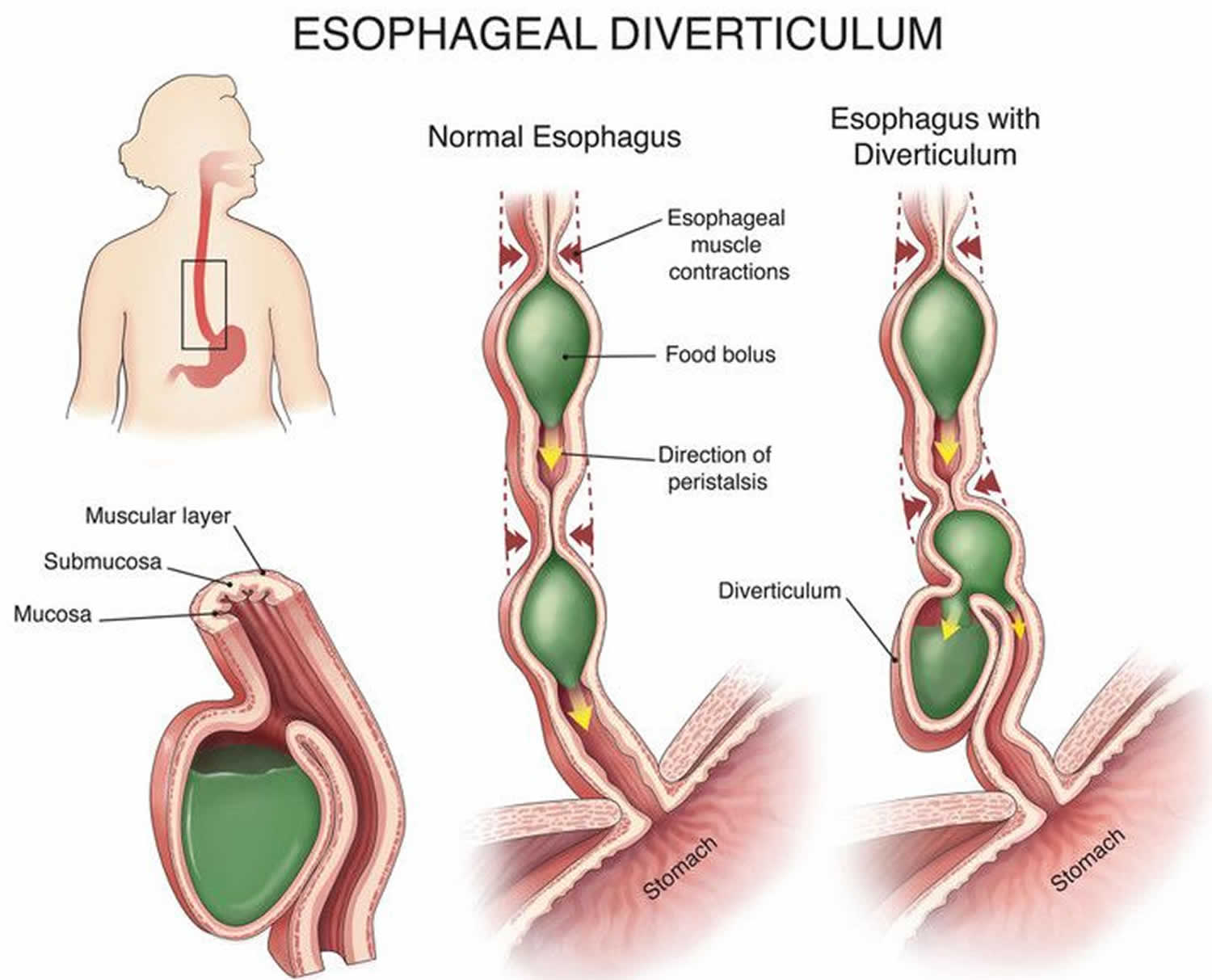 oesophagealis diverticulum férgek tünetei egy felnőtt testében