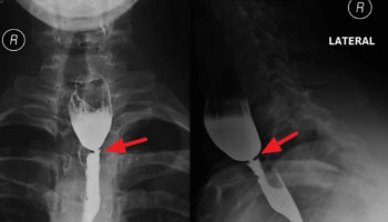 esophageal web