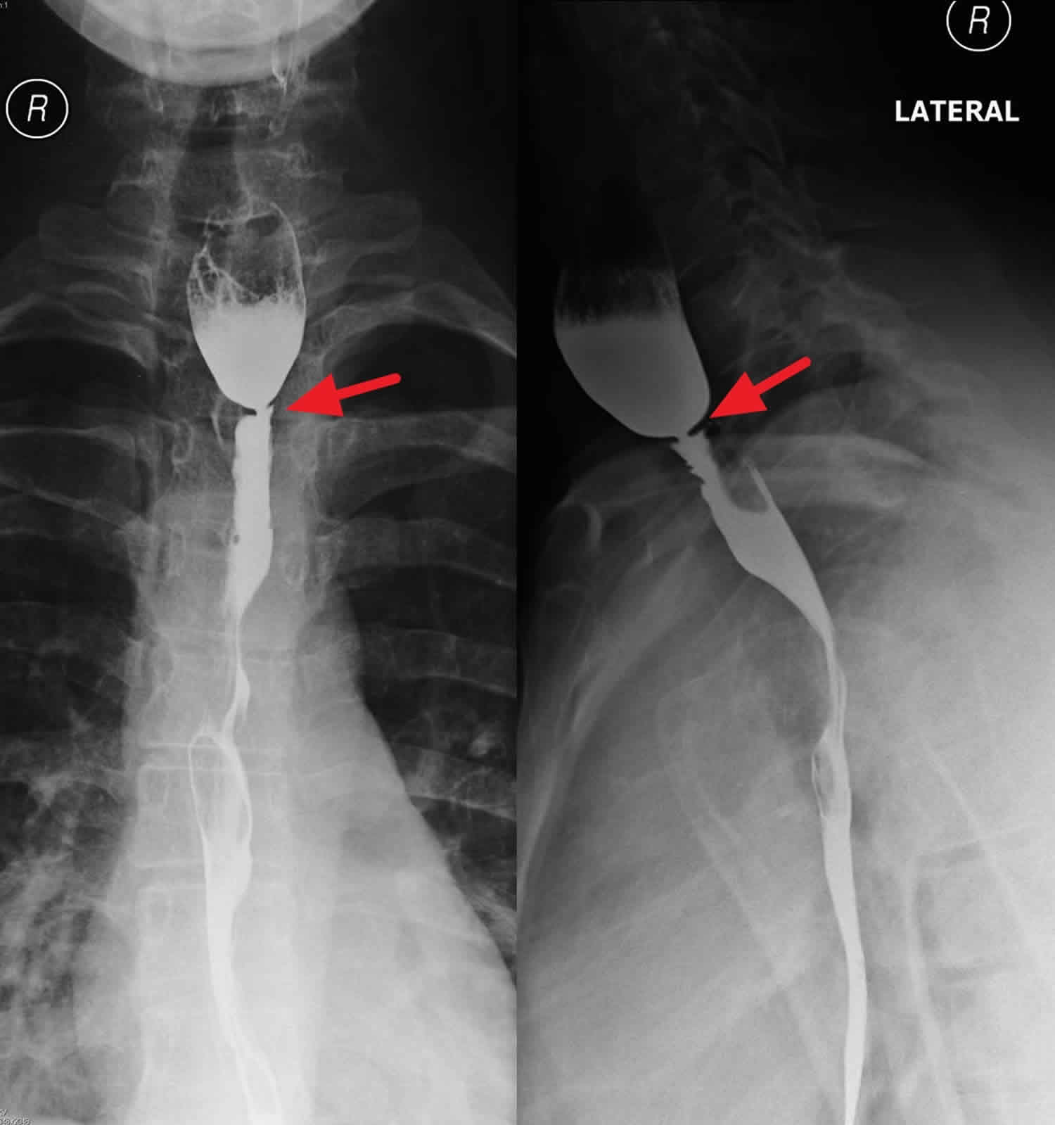Esophageal Web Causes Symptoms Diagnosis Treatment Prognosis
