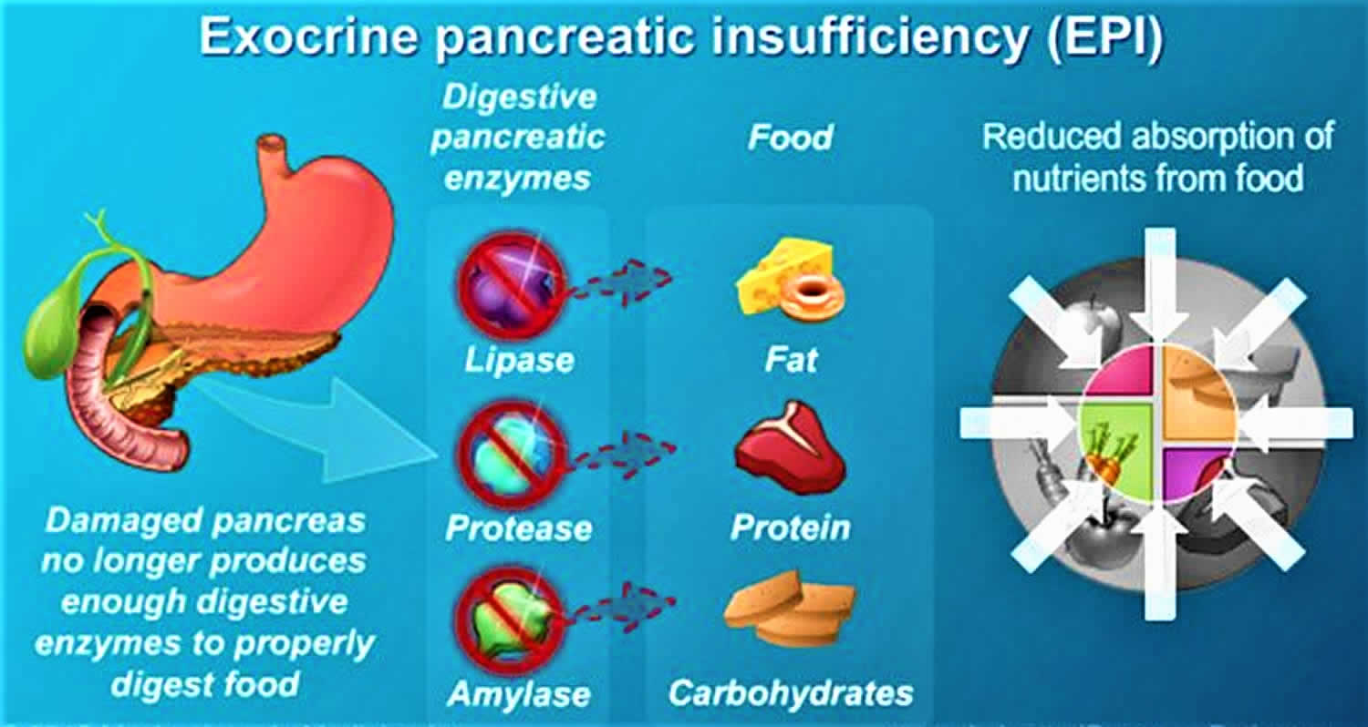 Exocrine Pancreatic Insufficiency Causes Symptoms Diagnosis Treatment