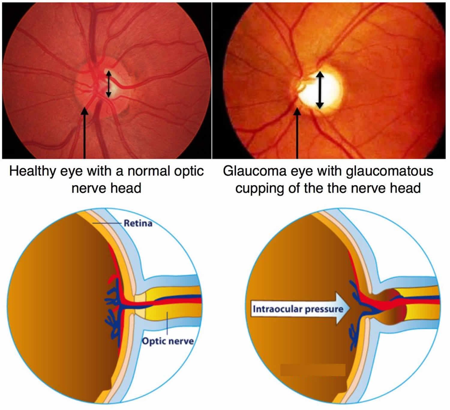 Глаукома латынь. Узкоугольная глаукома. Терминальная глаукома.