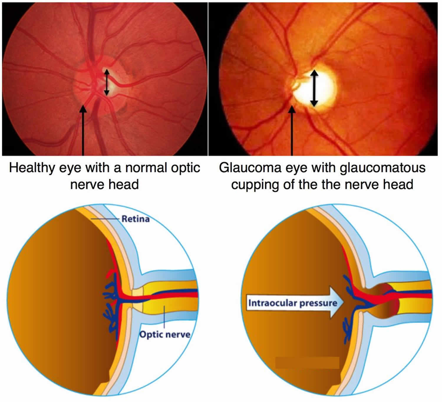 Intraocular Pressure Definition Normal Range Intraocular Pressure 