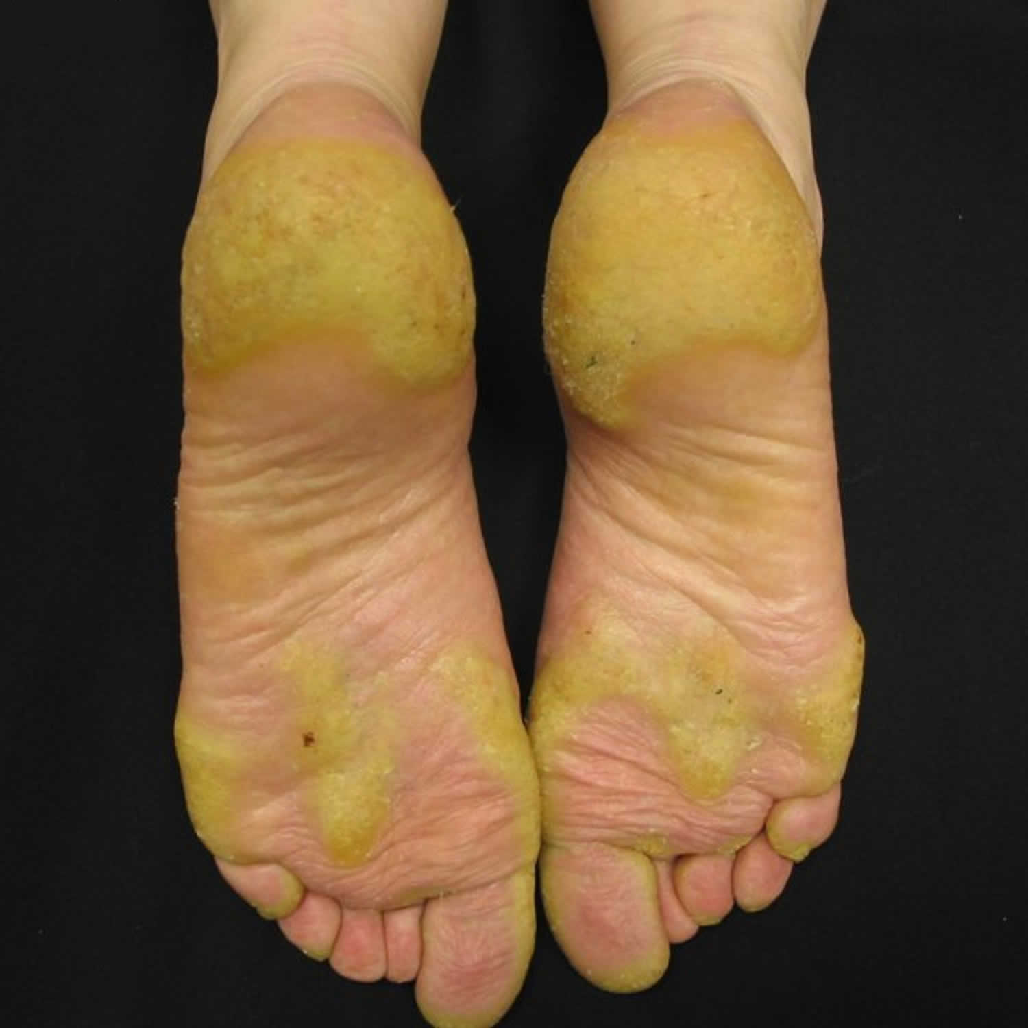 Hiperqueratosis Plantar