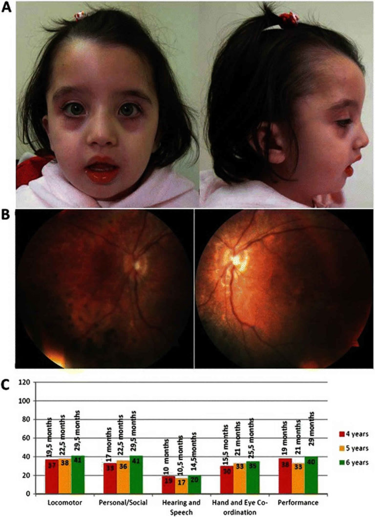 Refsum disease causes, symptoms, diagnosis, treatment & prognosis