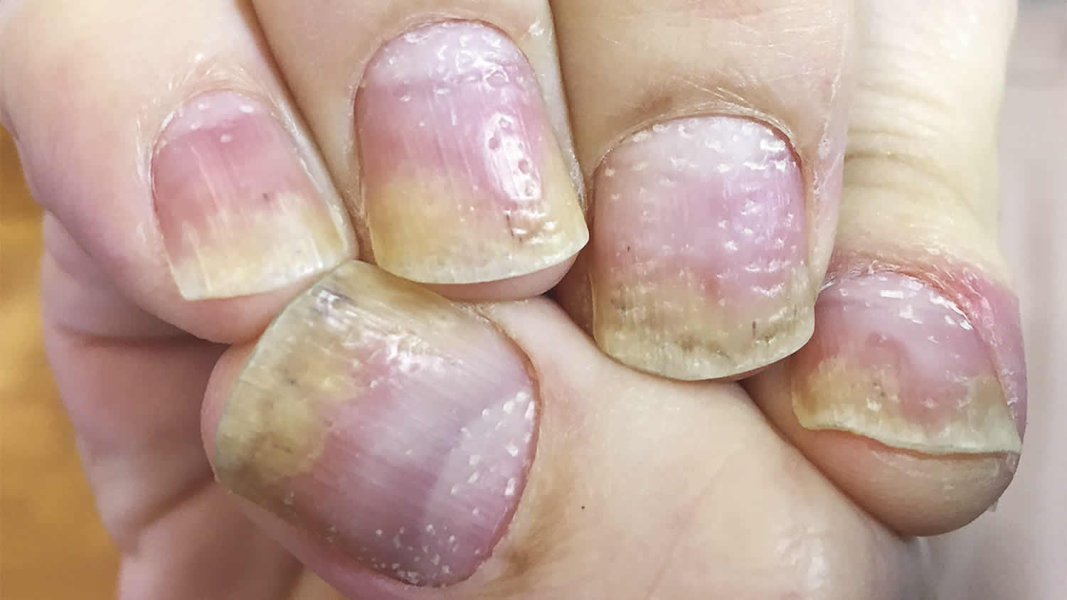 how to hide nail psoriasis