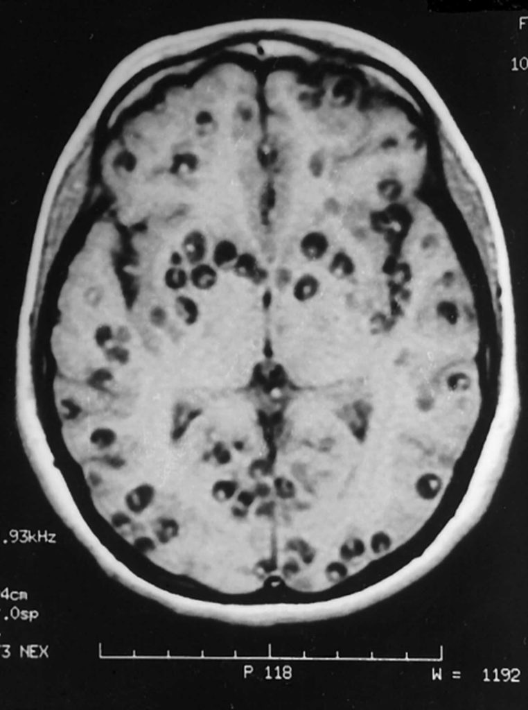 Neurocysticercosis Causes, Symptoms, Diagnosis, Treatment & Prognosis