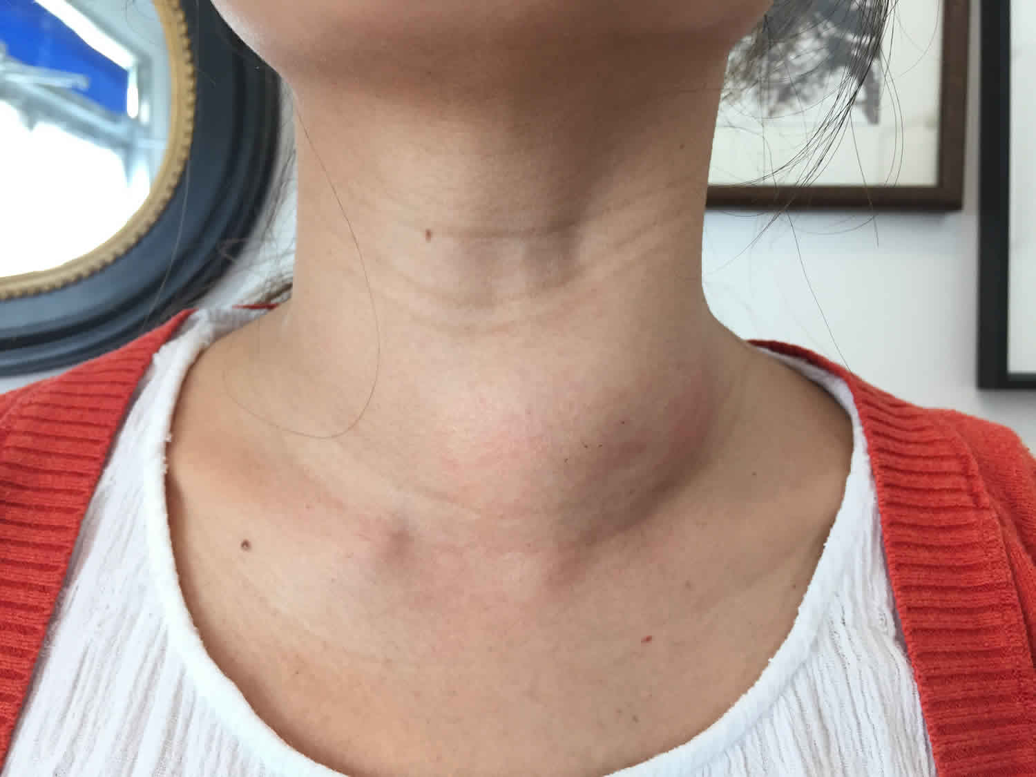 Nontoxic Goiter Causes Symptoms Diagnosis Treatment