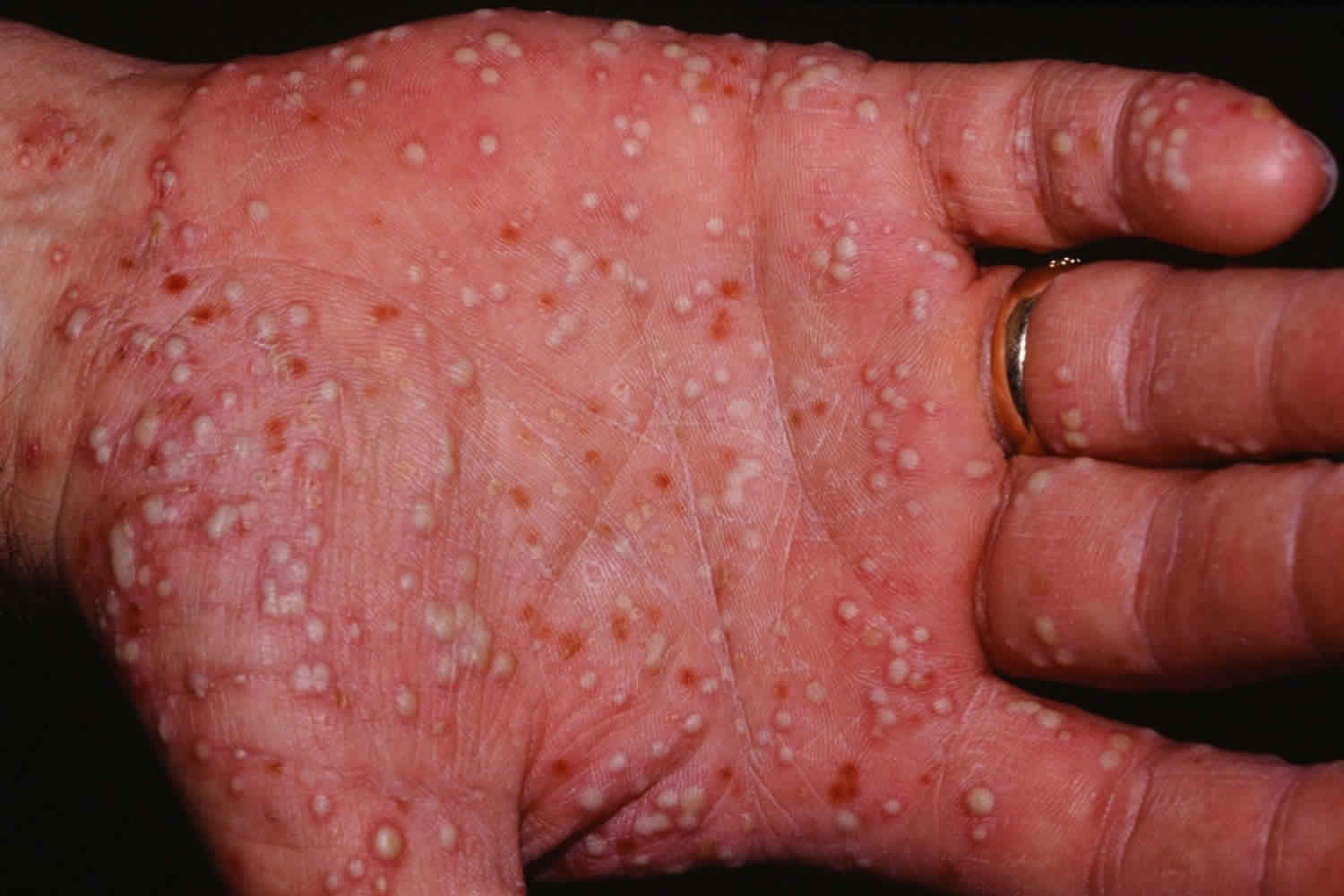 palmoplantar pustular psoriasis pictures