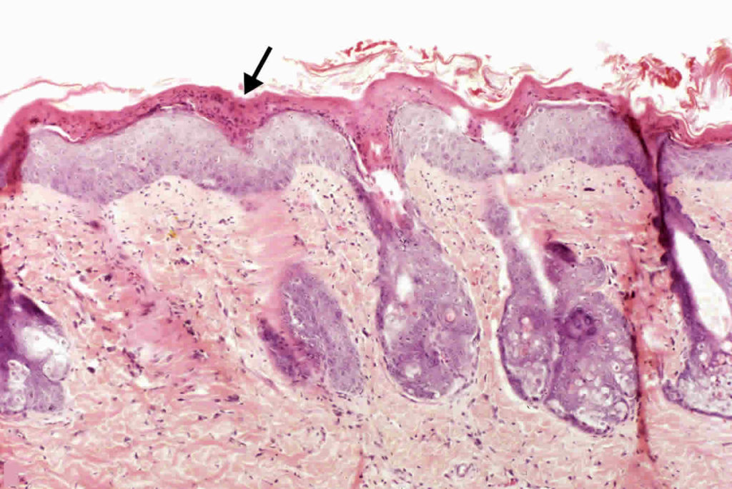 hyperkeratosis icd 9