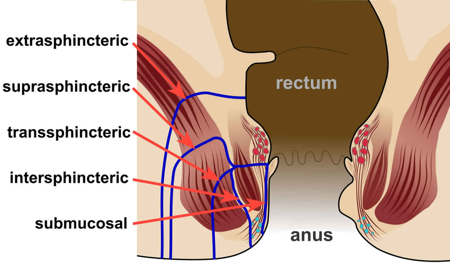 Causes Of Anal Fistulas