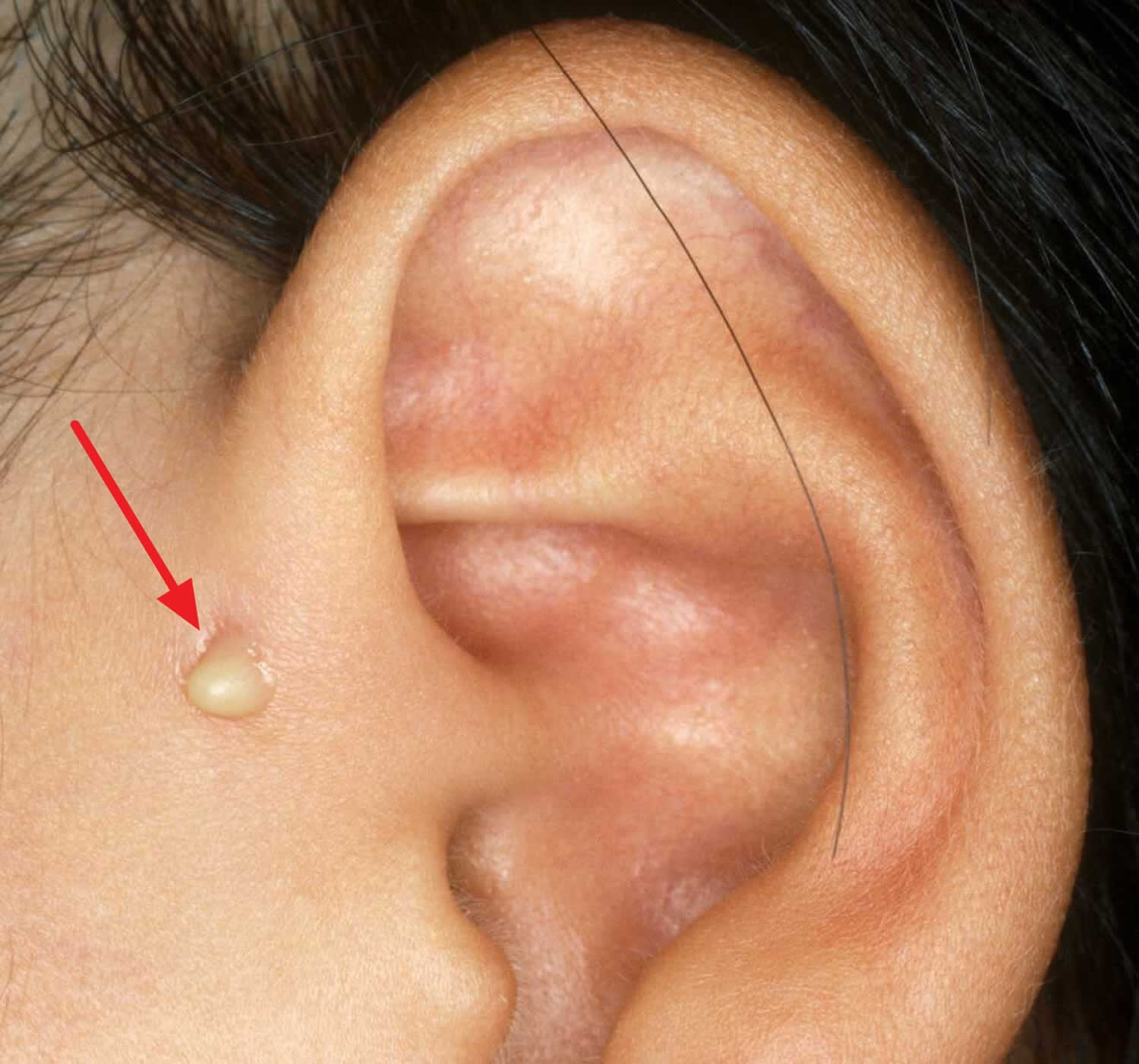 Preauricular Sinus Pit Or Cyst Causes Symptoms Diagnosis Treatment