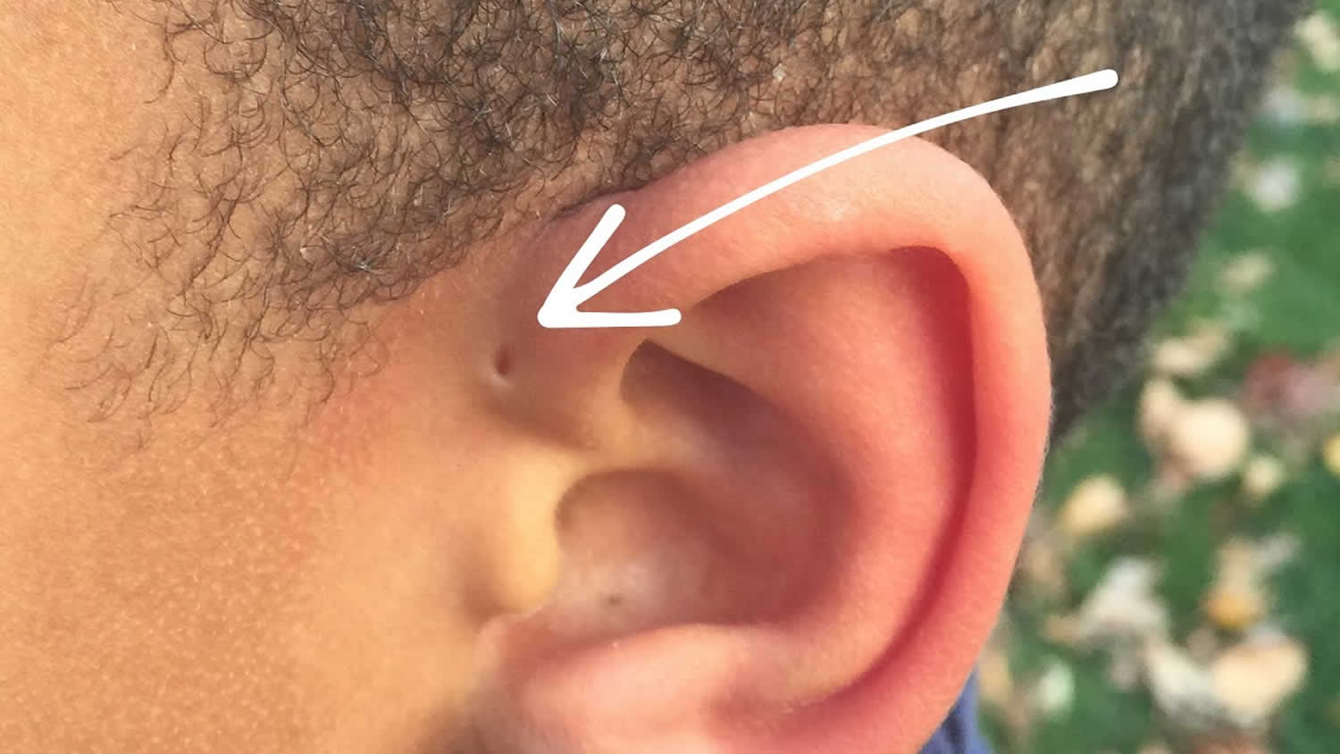 Symptoms Piercing Infection: 4 Ways to HEAL FAST pop an infected ear pierci...