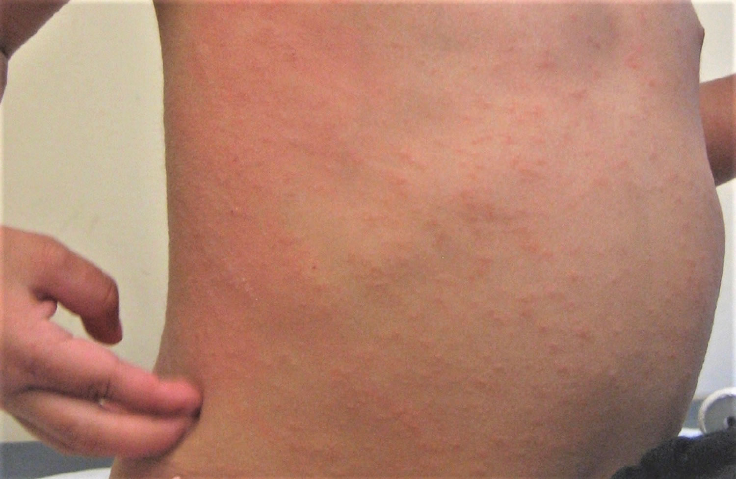 Skin Rash Definition English