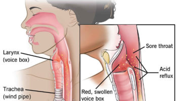 reflux laryngitis