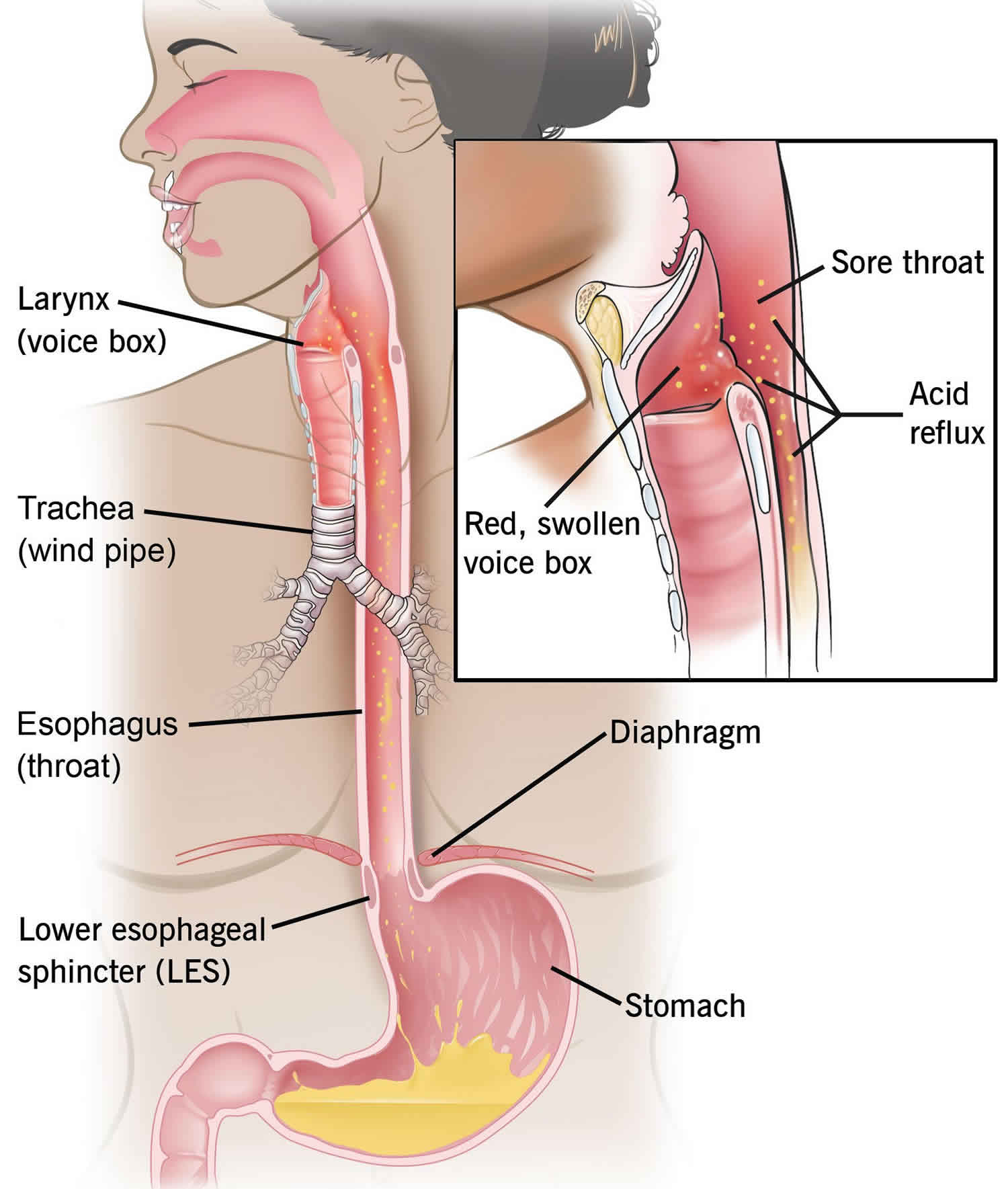 laryngitis diagram