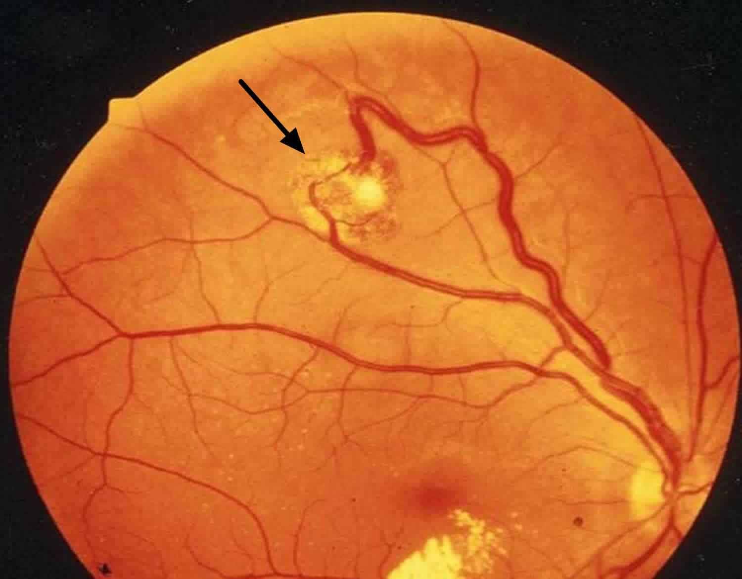 retina definition