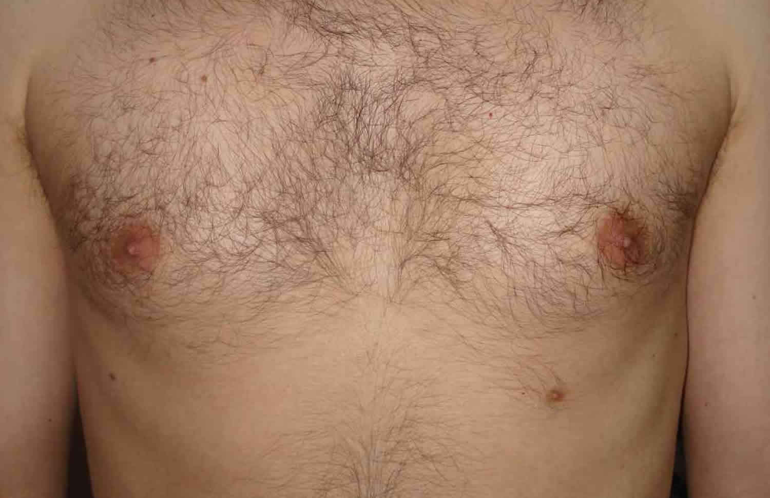 Supernumerary nipple causes, clinical features, diagnosis & treatment