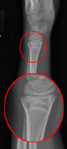 distal radius torus fracture treatment