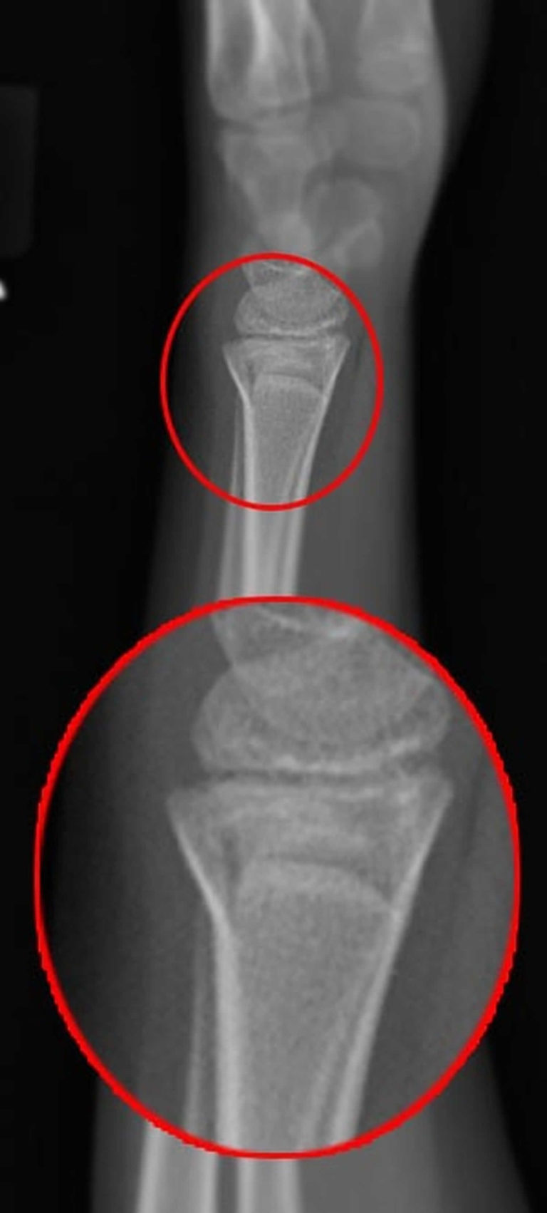 Torus fracture definition, causes, diagnosis & torus fracture treatment