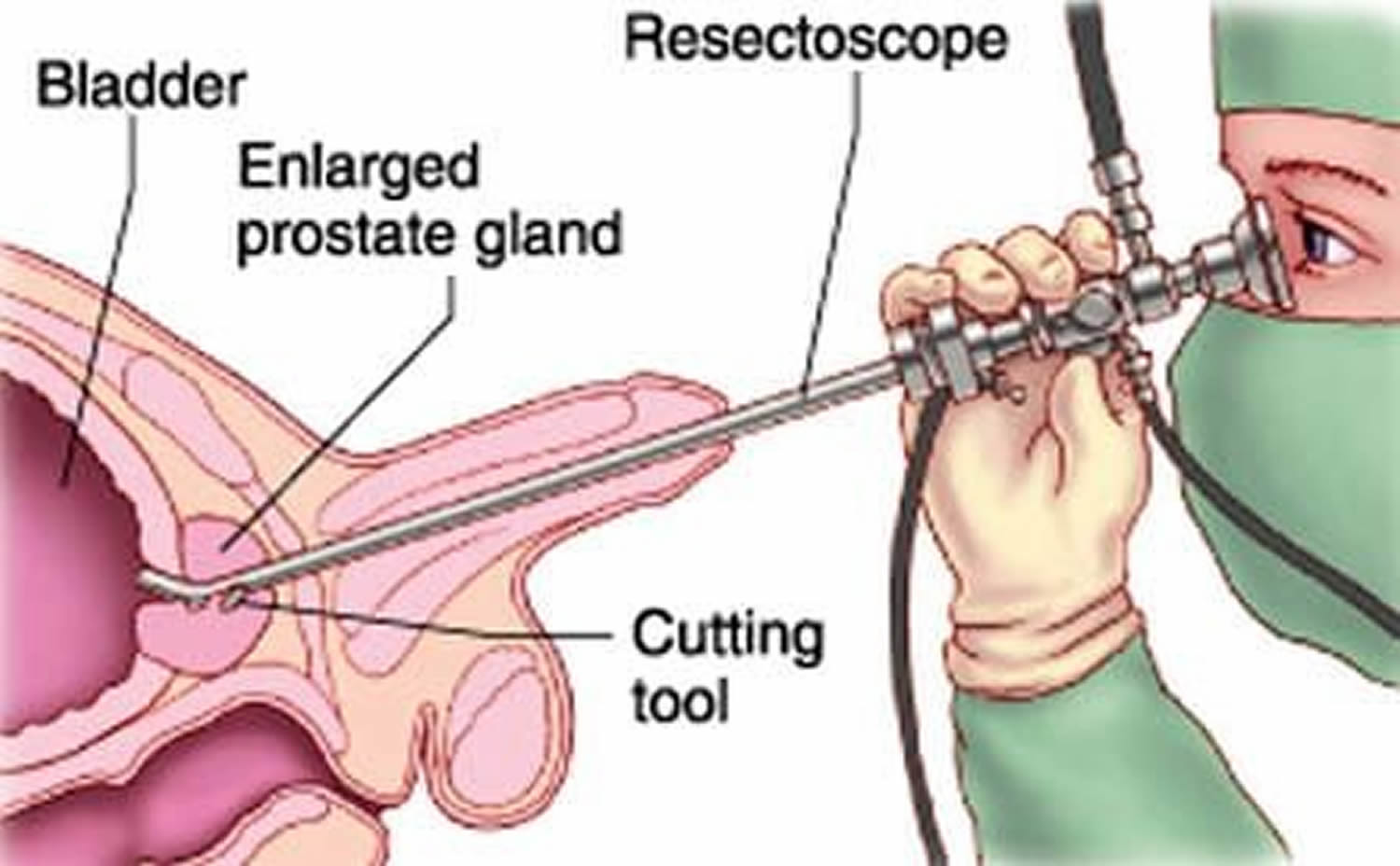 transuretral resection prostat)