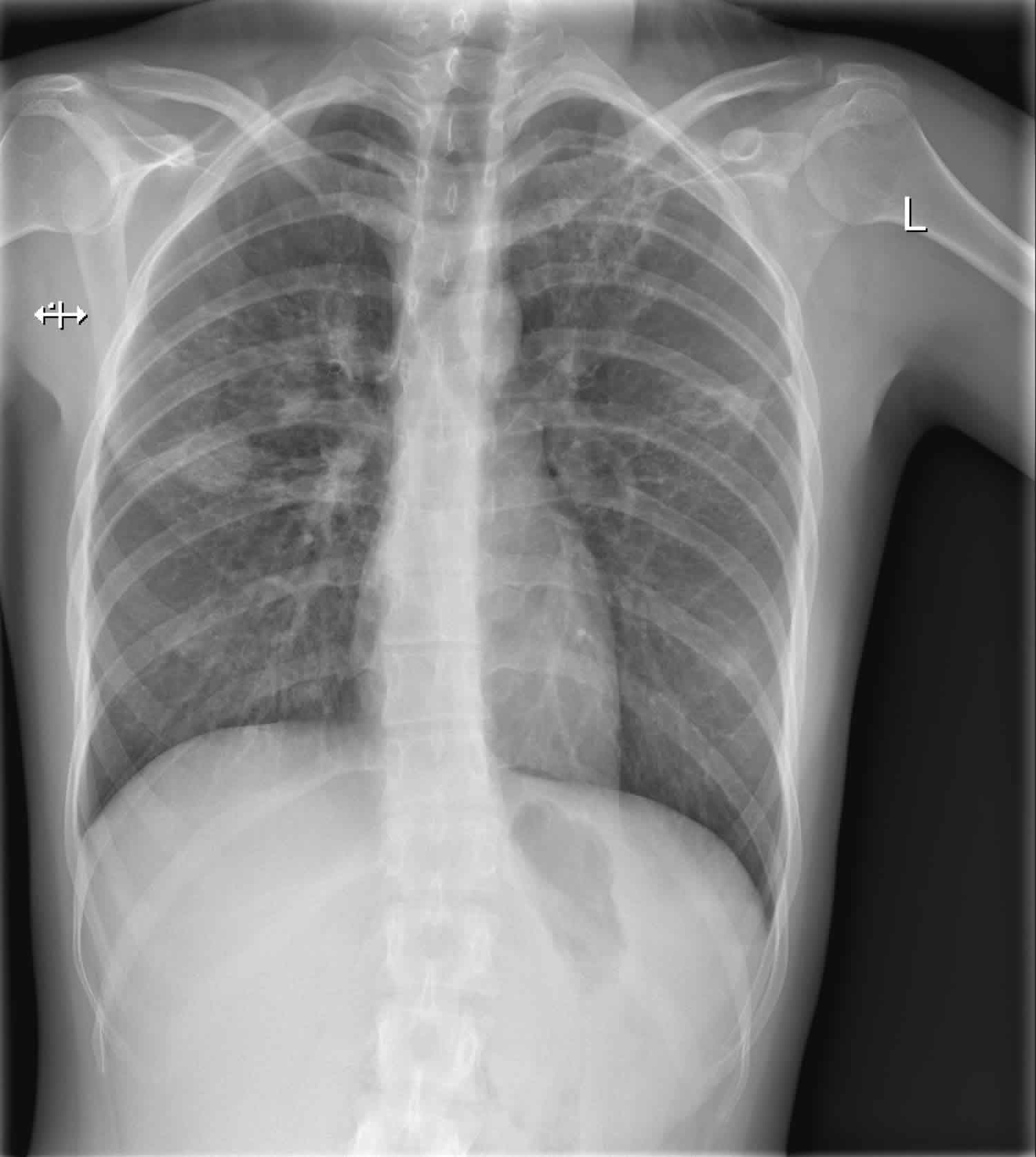 Three Examples Of Chest X Rays From The Tuberculosis